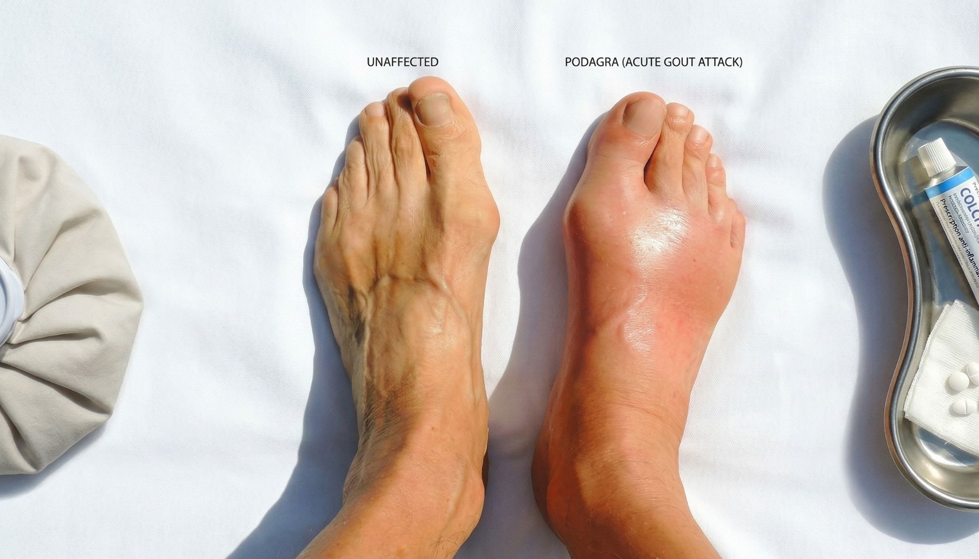 Gout (Vatarakta)
