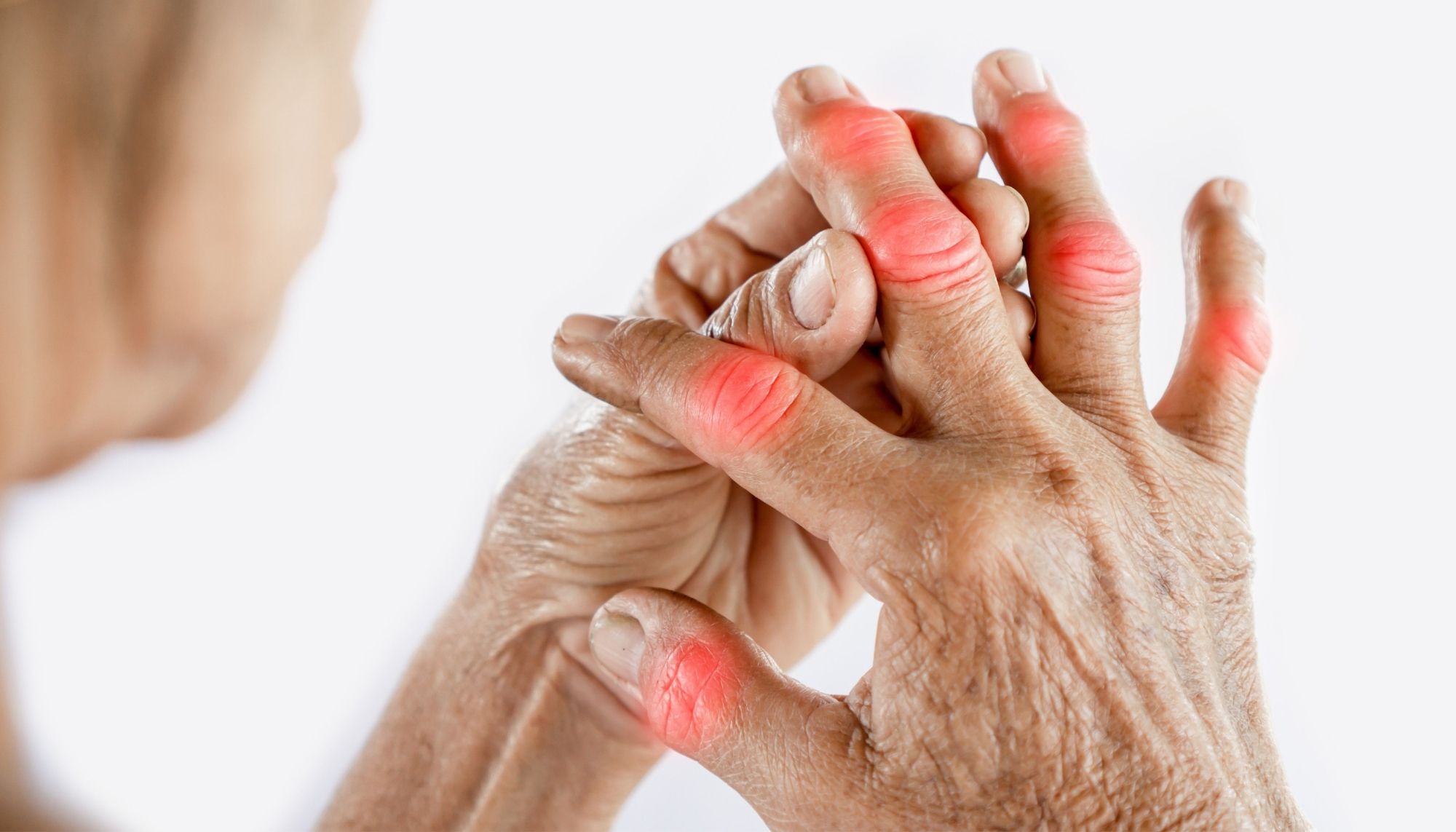 Rheumatoid Arthritis